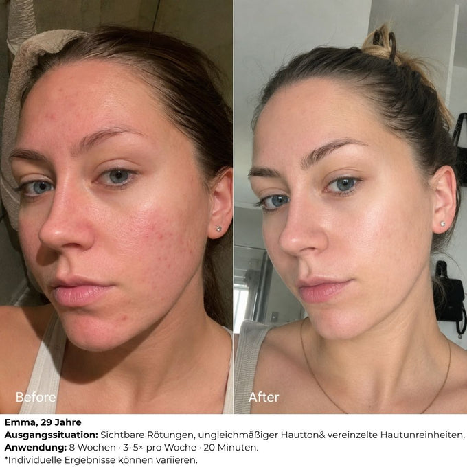 LED Face Mask für jede Frau